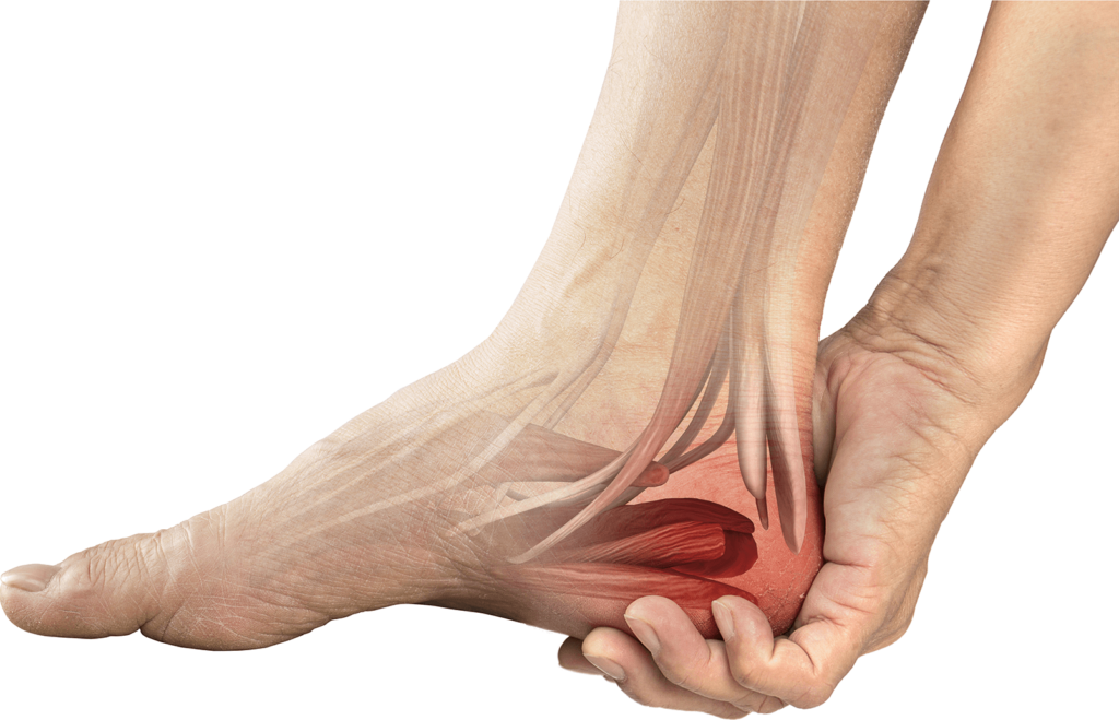 Heel Pain Plantar Fasciitis Sydney Podiatry Practice